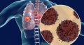 Cancerul pulmonar este mai frecvent la nefumatori