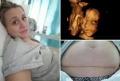 Copil nenascut scos din uterul mamei pentru a fi tratat, apoi pus la loc