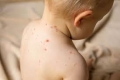 Pe fondul îngrijorării față de epidemiile de rujeolă, ONU avertizează că vaccinarea copiilor la nivel mondial stagnează